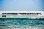 疫情皮肤瘙痒图片★疫情期间皮肤会出现什么问题